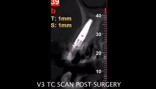 V3 MIS Implant - Immediate Loading of Bone-grafted Maxilla