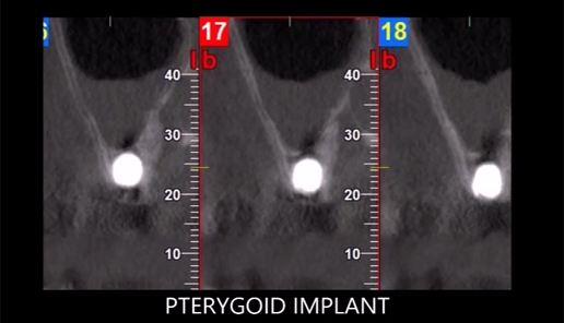 V3 MIS  and Pterygoid Surgery