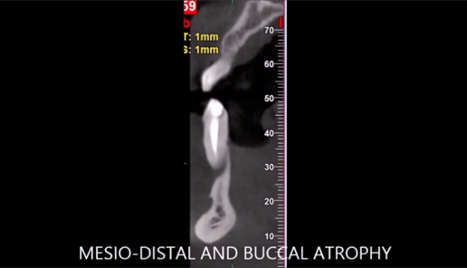 MIS 4BONE vertical GBR in Atrophic Jaw (part one)