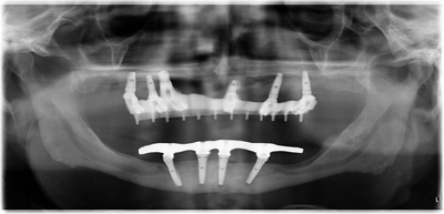 TILTED-IMPLANTS-WITH-IMMEDI