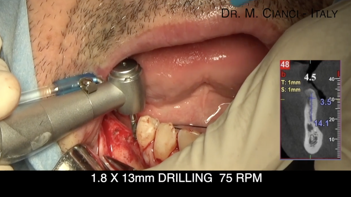 HORIZONTAL AND VERTICAL ATROPHY OF POSTERIOR JAW: NO-INVASIVE PROTOCOL WITH 3.0 NARROW AND ULTRA-SHORT IMPLANTS AND IMMEDIATE LOADING 