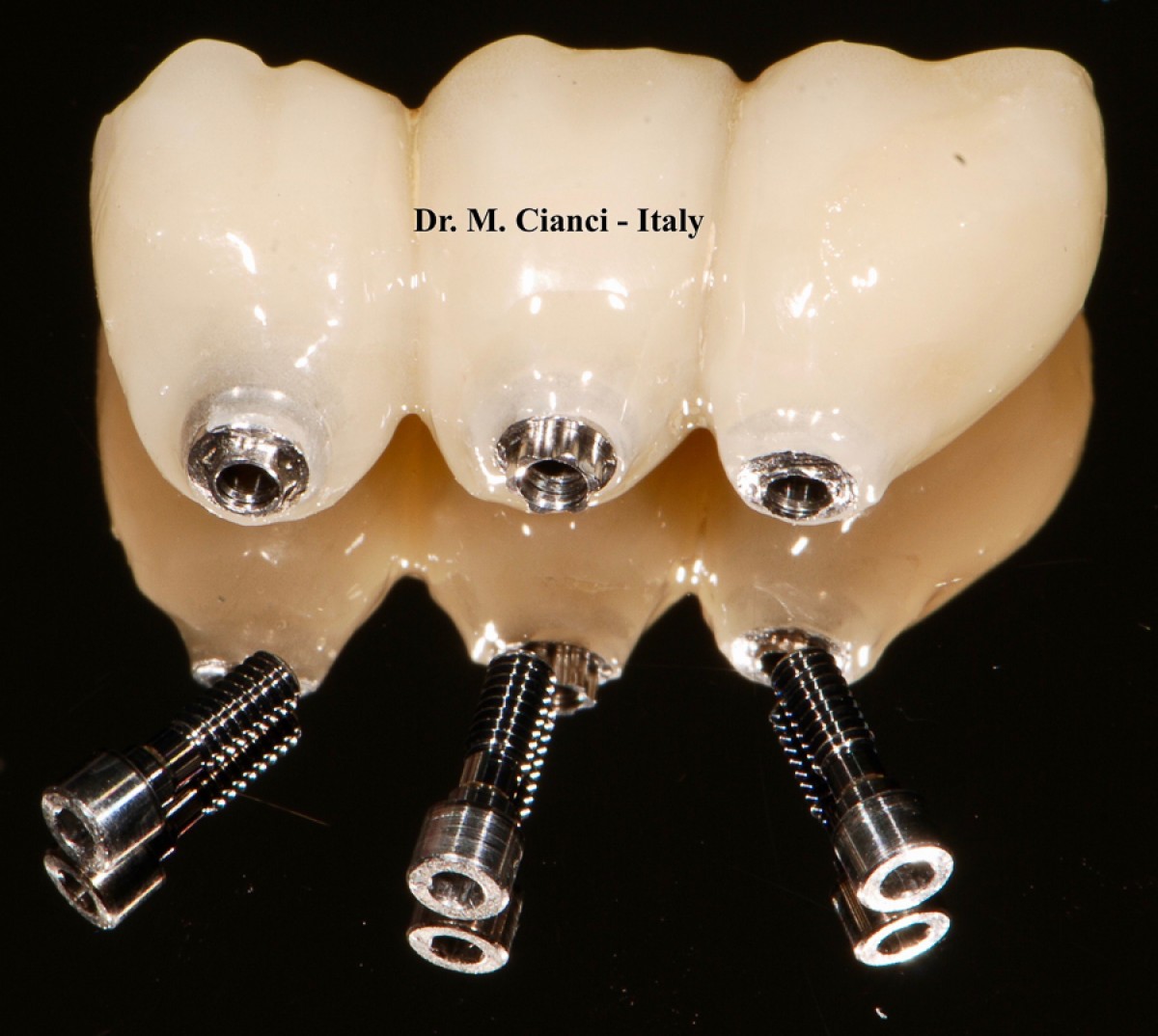 Horizontal and Vertical Atrophy of posterior jaw: no-invasive protocol with 3.0 narrow and ultra-short implants and immediate loading