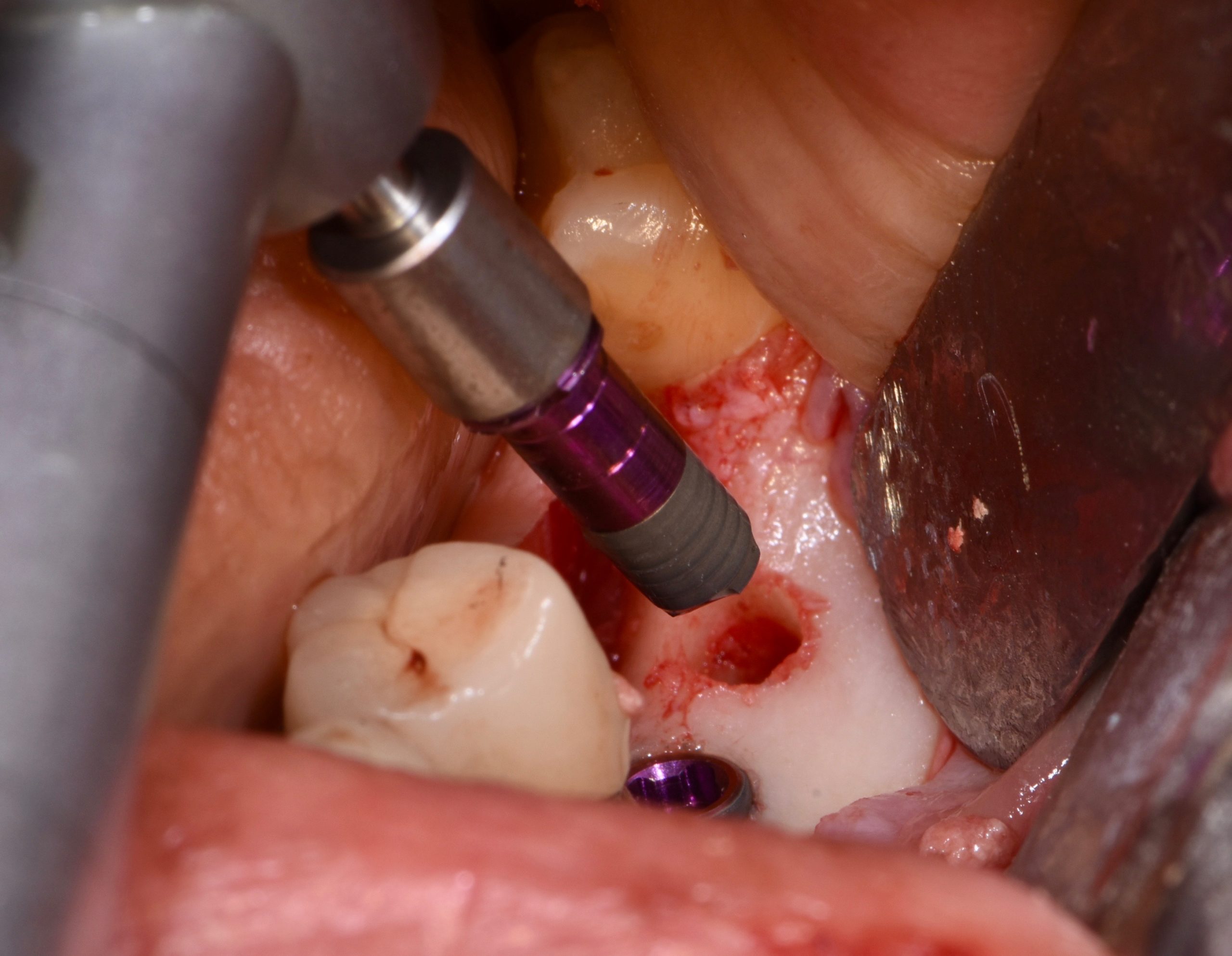 EXTRA-SHORT 4.5mm IMPLANTS AND DIGITAL IMMEDIATE LOADING
