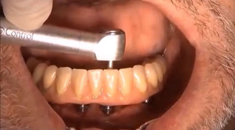 Tilting implants and immediate loading full mouth Rehabilitation