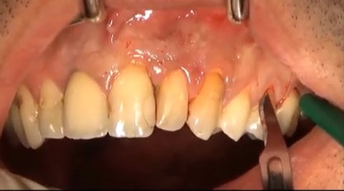 Maxilla cystis removing with Apicoectomy